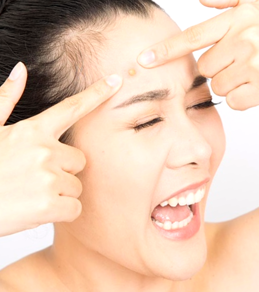 remedios caseros para eliminar el acné